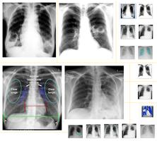Chest X-Ray And Pathology Affiche