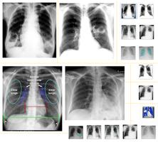 Chest X-Ray And Pathology bài đăng