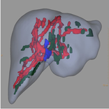 Child-Pugh (CP) Classification