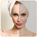 Pimple Remover Acne Remover aplikacja