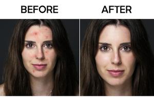 Pimple Remover Acne Remover تصوير الشاشة 1