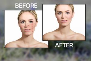Pimple Remover Acne Remover تصوير الشاشة 3