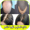 علاج تساقط الشعر بالثوم في يومين