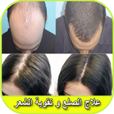 علاج تساقط الشعر بالثوم في يومين icono