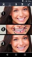 Braces On Photo poster