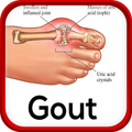 Gout Disease