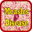 Measles Disease