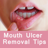 Mouth Ulcer Removal Tips icône