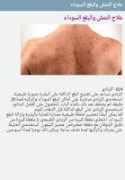علاج النمش والبقع السوداء 截图 1
