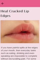 How To Heal Cracked Lips screenshot 1