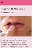 How To Heal Cracked Lips screenshot 2