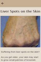How To Remove Liver Spots Affiche