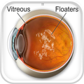 Floater Disease
