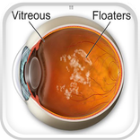 Floater Disease