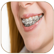 Braces Photo Editor - Braces F