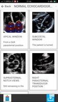 ECHOCARDIOGRAPHY GUIDE capture d'écran 2