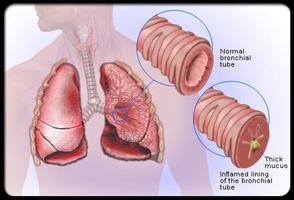 1 Schermata Dealing With Bronchitis