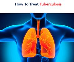 How To Treat Tuberculosis โปสเตอร์