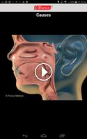 3 Schermata Otitis Media