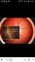 Glaucoma تصوير الشاشة 3