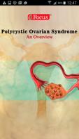 Polycystic Ovarian Syndrome الملصق