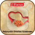 Polycystic ovarian syndrome