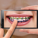 Kawat gigi di Foto. Editor APK