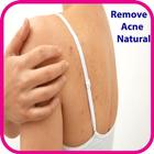 Remove Acne on Back icône