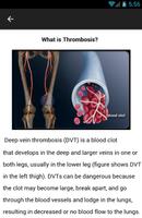 Thrombosis Symptoms स्क्रीनशॉट 3