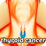 Thyroid Cancer Symptoms