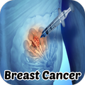 Breast Cancer Symptoms