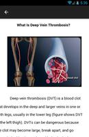 Deep Vein Thrombosis ภาพหน้าจอ 2