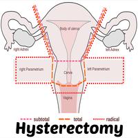 Hysterectomy Affiche