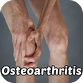 ”Osteoarthritis Symptoms