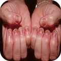 Psoriatic Arthritis
