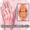 Rheumatoid Arthritis