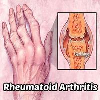 Rheumatoid Arthritis Affiche