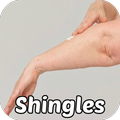 Shingles