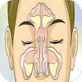 Sinusitis