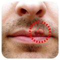 Cold Sores