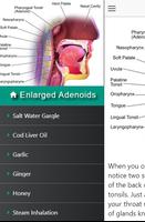 Cure Enlarged Adenoids in Children - Adenoidectomy capture d'écran 1