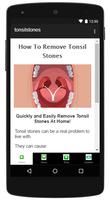 How To Remove Tonsil Stones Affiche