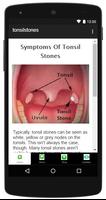 How To Remove Tonsil Stones capture d'écran 2
