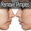 How to Remove Pimples