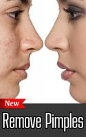 How to Remove Pimples 海报