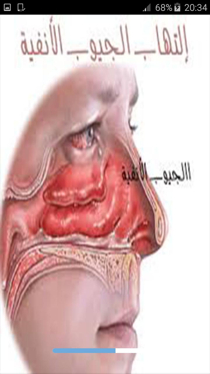 علاج الجيوب الأنفية في المنزل