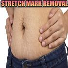 Natural Stretch Marks Removal icône
