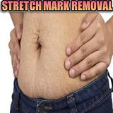 Natural Stretch Marks Removal icône