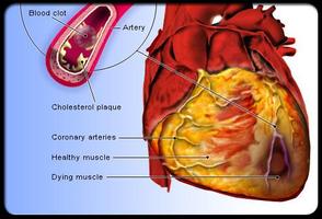 Guide Coronary Artery Disease capture d'écran 3