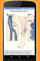 Como eliminar varices en piernas. Tratamiento স্ক্রিনশট 2